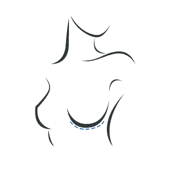 Brustvergrößerung - Schnitt unter der Brust